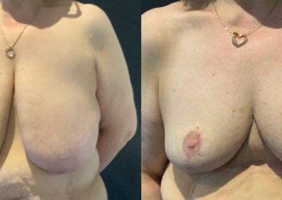 Bilateral breast reduction with liposuction (pre and 6 weeks)