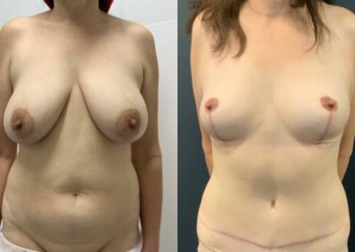 Bilateral breast reduction + Abdominoplasty – pre-op & 3 months post-op