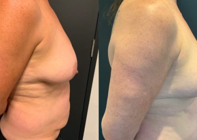Procedure Breast lift+abdominoplasty