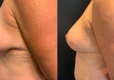 Procedure Breast lift+abdominoplasty