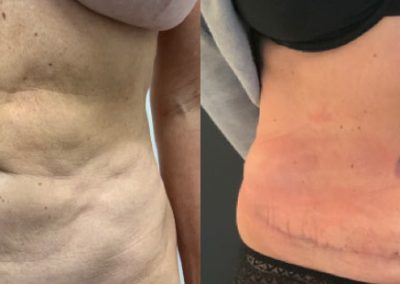 Scar revision via Mini Abdominoplasty – pre-op & 6 weeks post-op