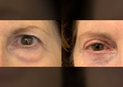 Upper eyelids – pre-op & 4 months post-op