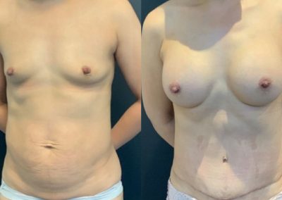 Bilateral Breast Augmentation + Abdominoplasty With Rectus Divarication Correction – Pre-op and 12 months post-op