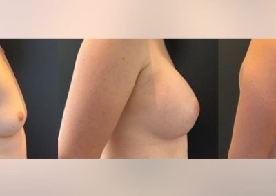 Bilateral breast augmentation pre surgery - 6 weeks and 3 months - Post opt