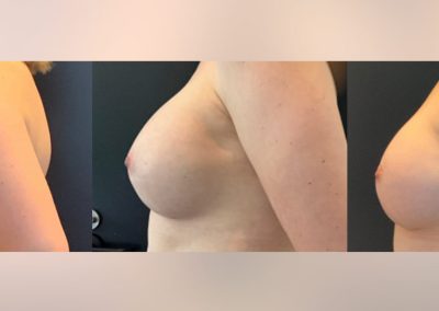Bilateral breast augmentation pre surgery - 6 weeks and 3 months - Post opt
