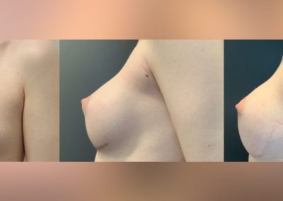 Bilateral breast augmentation and fat grafting pre surgery - 3 months and 6 months post op