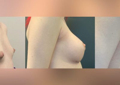 Bilateral breast augmentation and fat grafting pre surgery - 3 months and 6 months post op