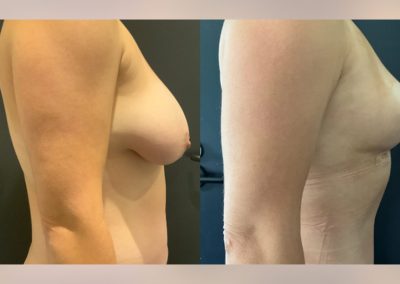 Bilateral breast reduction and abdominoplasty with muscle repair - pre vs 3months post op
