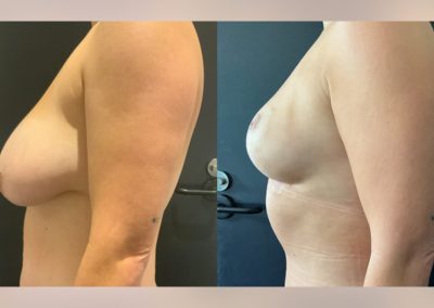 Bilateral breast reduction and abdominoplasty with muscle repair - pre vs 3months post op