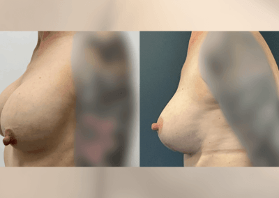 Bilateral changeover of breast implants and breast lift - 4 months post op
