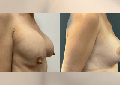 Bilateral changeover of breast implants and breast lift - 4 months post op