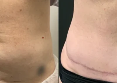 Abdominoplasty & Removal of multiple abdominal surgery scars – pre-op & 7 months post-op