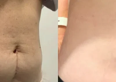 Abdominoplasty and Removal of multiple abdominal surgery 2