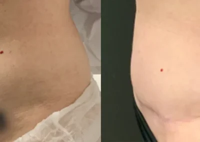 Abdominoplasty and Removal of multiple abdominal surgery post op