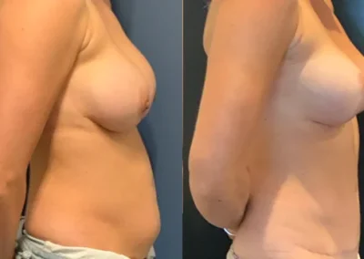 Bilateral Changeover Breast Abdomen 3