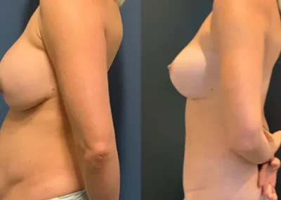 Bilateral Changeover Breast Abdomen