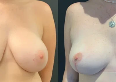 Bilateral breast reduction – pre-op & 6 months post-op